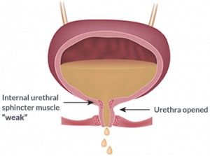 Urinary Incontinence Weak muscle illustration