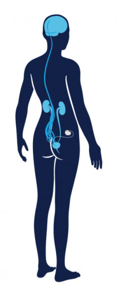 InterStim™ Device on the body illustration